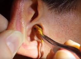 Ear Wax Paediatrics (up to age 14) - £100